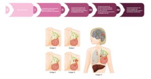 Infográfico apresenta estágios do câncer de mama