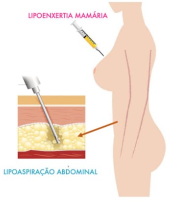 Infográfico apresenta técnica enxertia - cirurgia oncoplástica