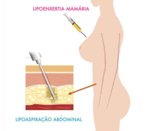Infográfico apresenta técnica enxertia - cirurgia oncoplástica