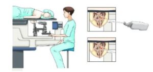 ilustração apresenta técnica de mamotomia
