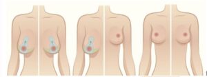 ilustração apresenta técnica de cirurgia da mama