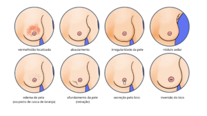 Infográfico apresenta sinais e sintomas do câncer de mama