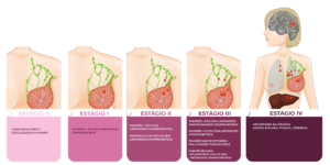 Infográfico apresenta evolução da metástase conforme o estágio do câncer de mama