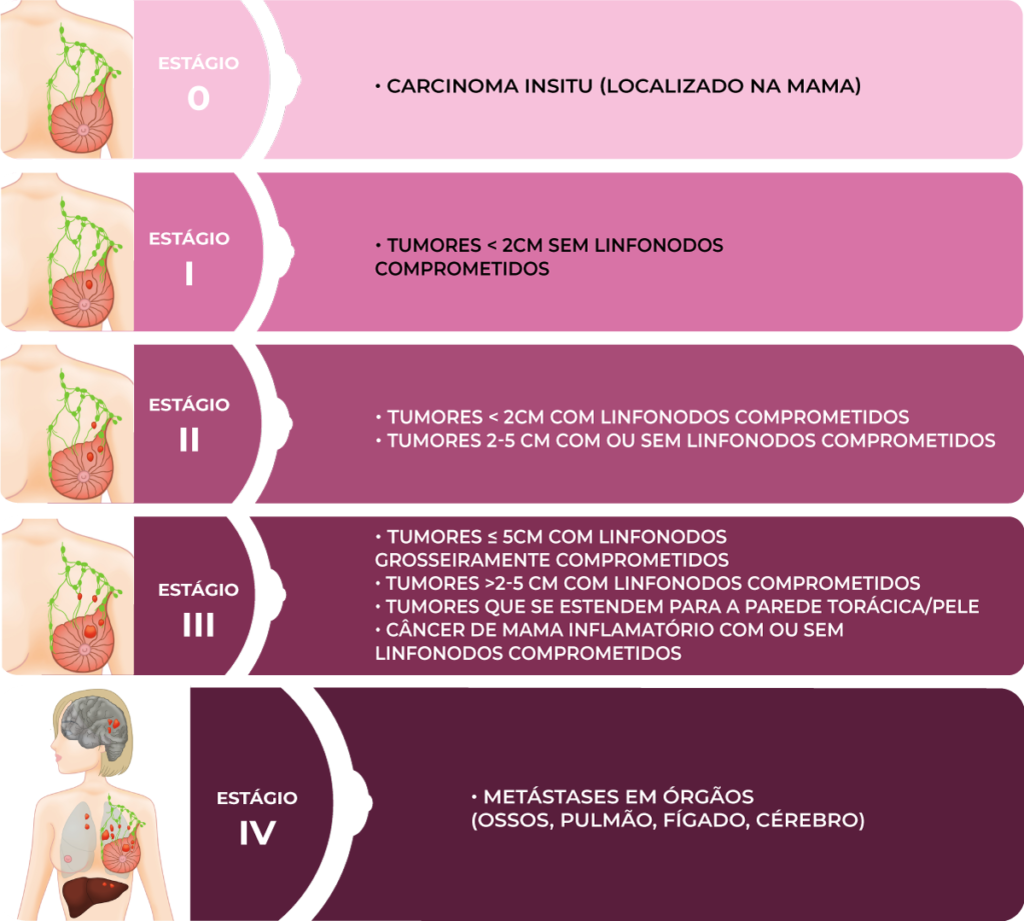 Estágios do câncer de mama