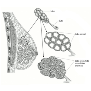 Infográfico da estrutura da mama - lobo e duto
