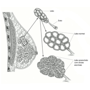 Infográfico apresenta estrutura da mama - lobo e duto