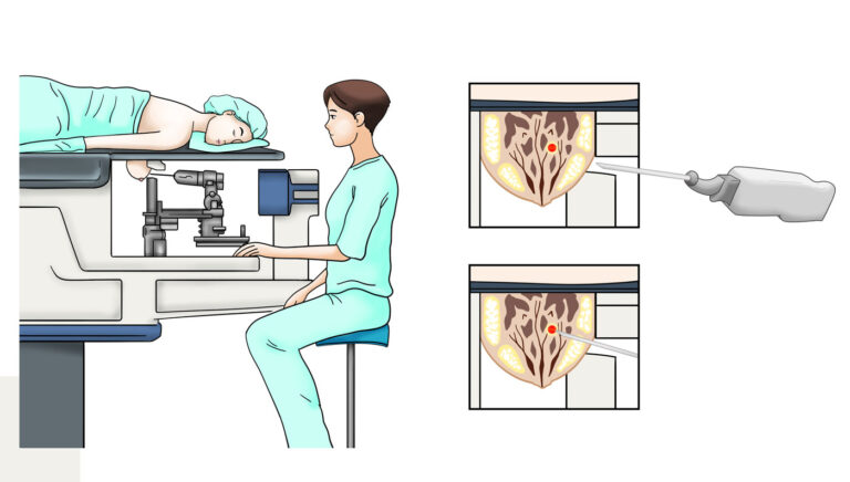 Tipo de biópsia de cânce de mama guiada por ultrassom ou mamografia