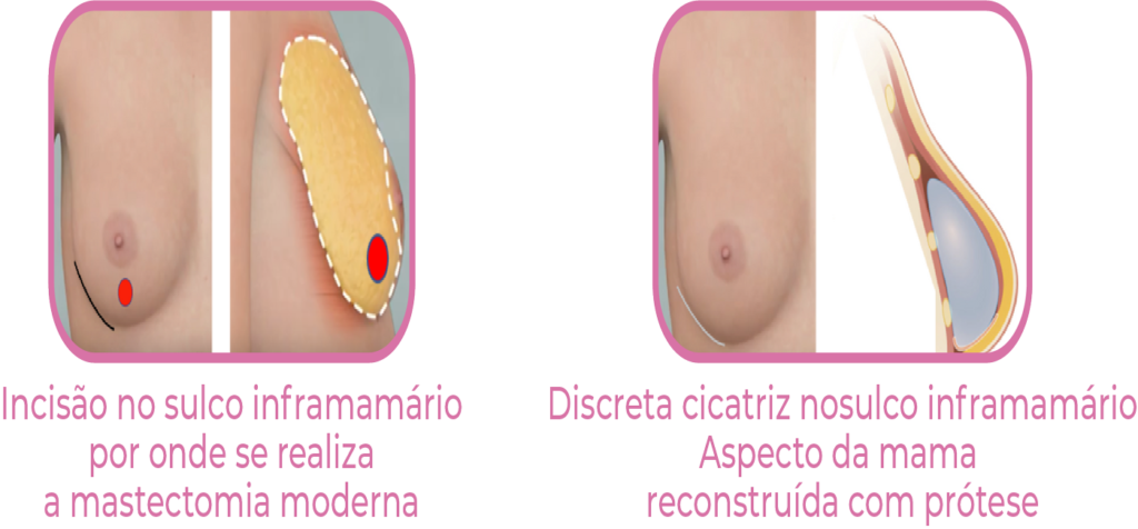 Técnicas de reconstrução mamária após mastectomia