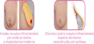 Técnicas de reconstrução mamária após mastectomia