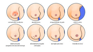 Infográfico apresenta sinais e sintomas do câncer de mama
