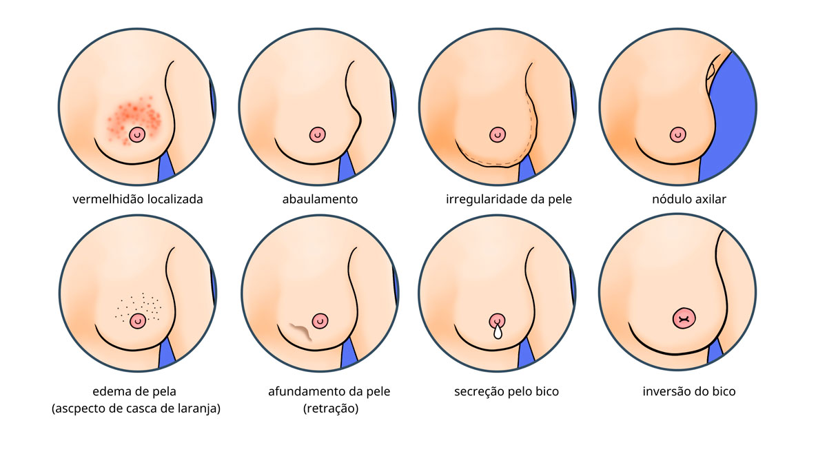 Infográfico apresenta sinais e sintomas do câncer de mama