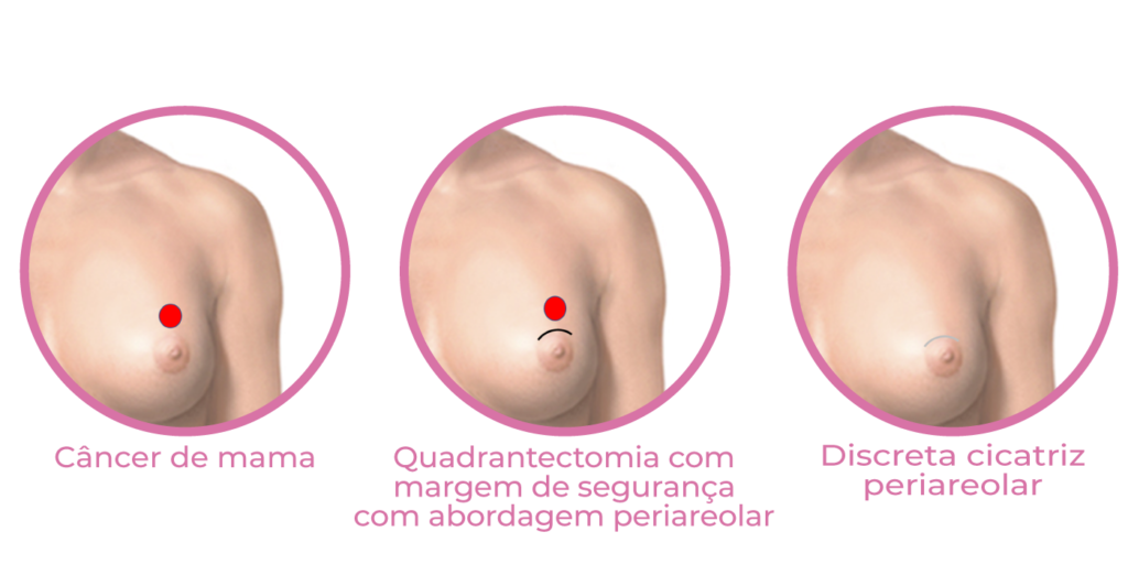 Infográfico apresente etapas da cirurgia conservadora de mama - quadrantectomia