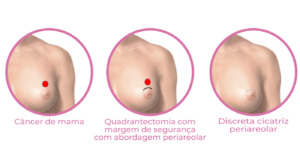 Infográfico apresente etapas da cirurgia conservadora de mama - quadrantectomia