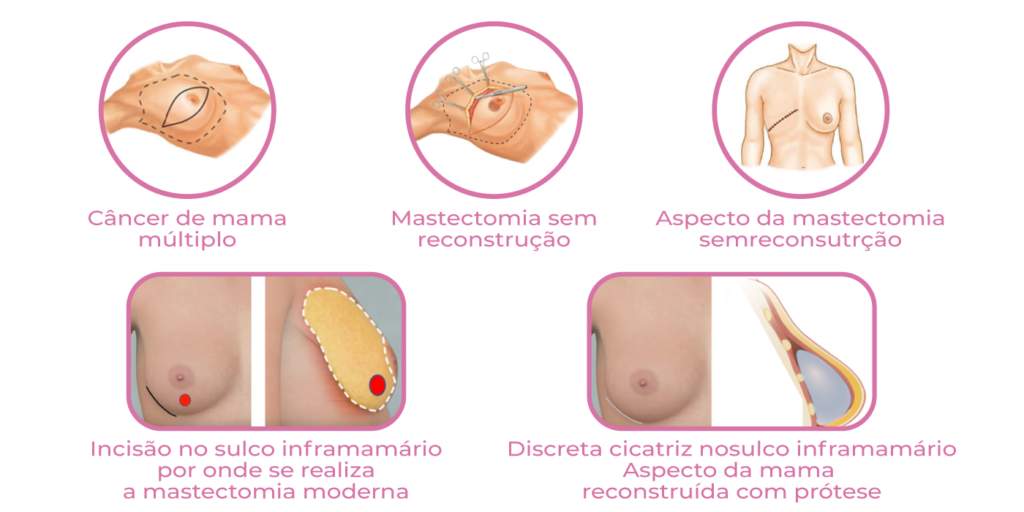 Infográfico apresente tipos de cirurgia da mama