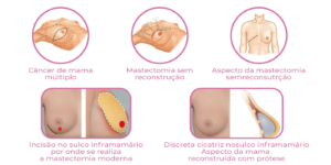 Infográfico apresente tipos de cirurgia da mama
